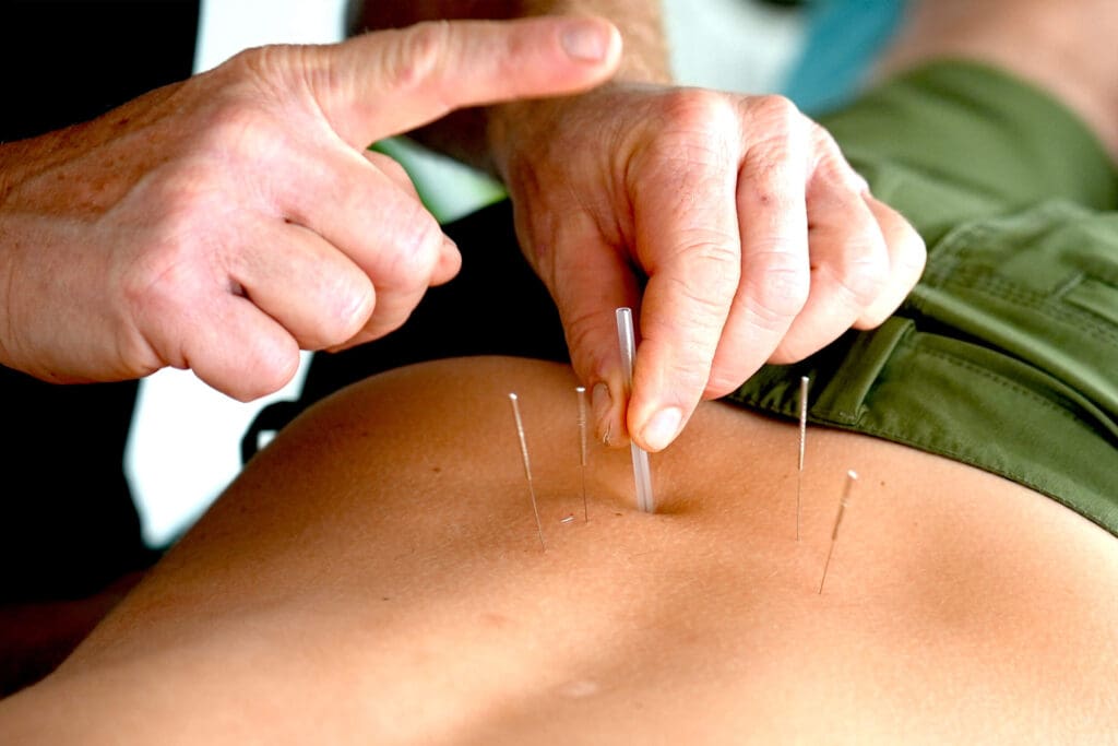 dry_needling_bonny_hills_laurieton_lake_cathie_hero_s